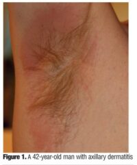 allergic reaction deodorant