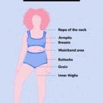 Alt text: Hidradenitis suppurativa symptoms, including boil-like lumps and bumps on the skin.