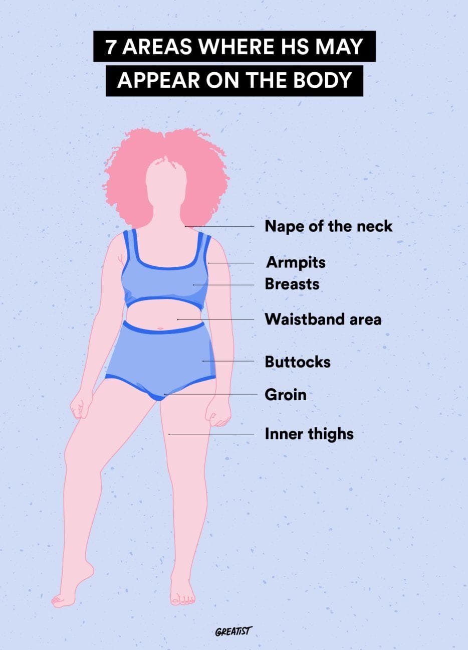 7 Places on the Body That Hidradenitis Suppurativa Can Appear 1 Alt text: Hidradenitis suppurativa symptoms, including boil-like lumps and bumps on the skin.