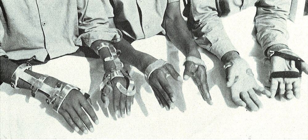 Victimes de l'épidémie de l'huile de cuisson empoisonnée au Maroc en 1959.