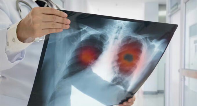 Infographie montrant des pourcentages de cancers évitables et des facteurs de risque comme le tabac, l'alcool, les infections et la pollution.