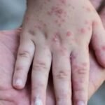 صورة توضيحية لمطعوم الجدري المائي الذي سيبدأ تقديمه في الأردن