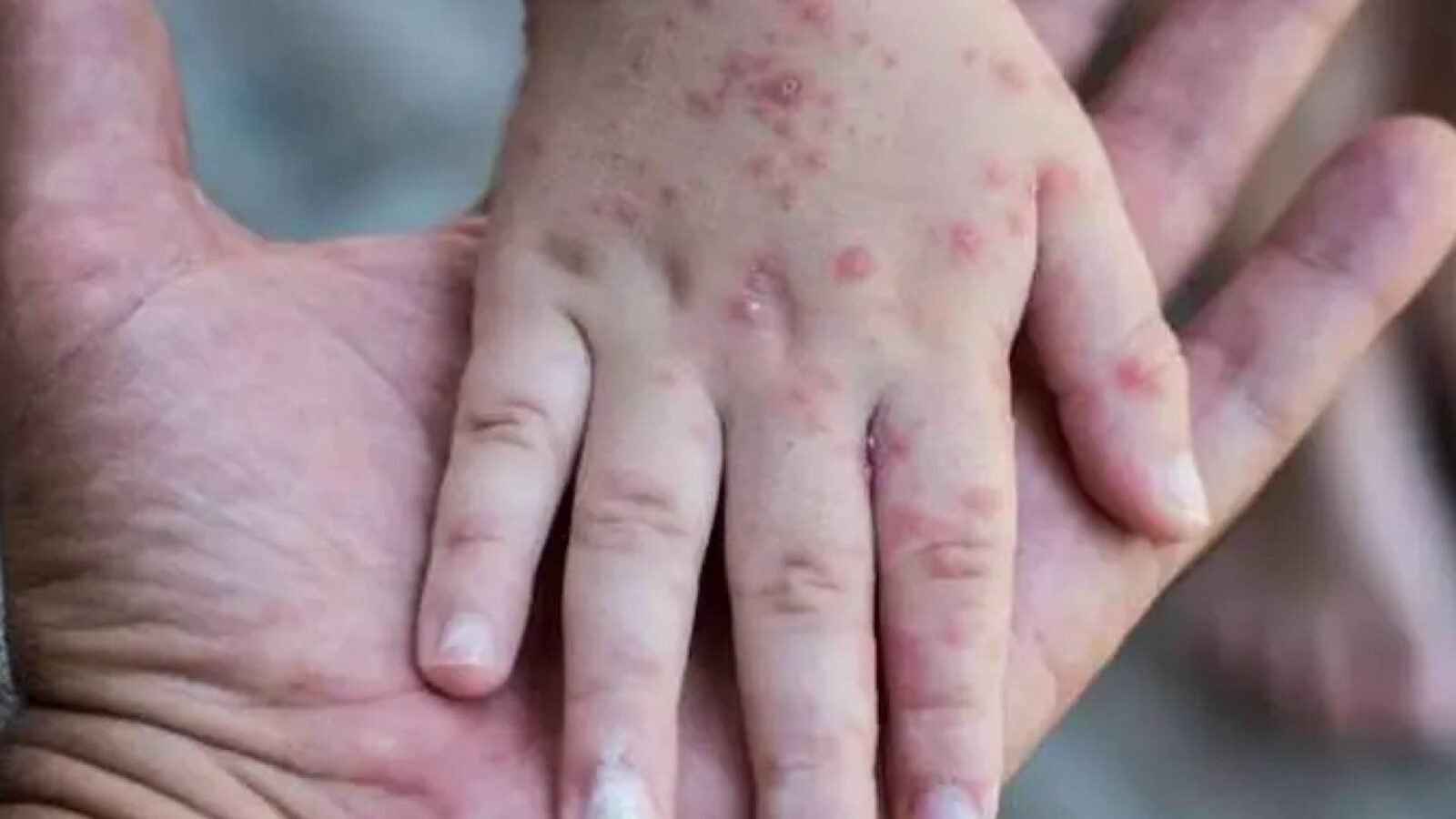 صورة توضيحية لمطعوم الجدري المائي الذي سيبدأ تقديمه في الأردن