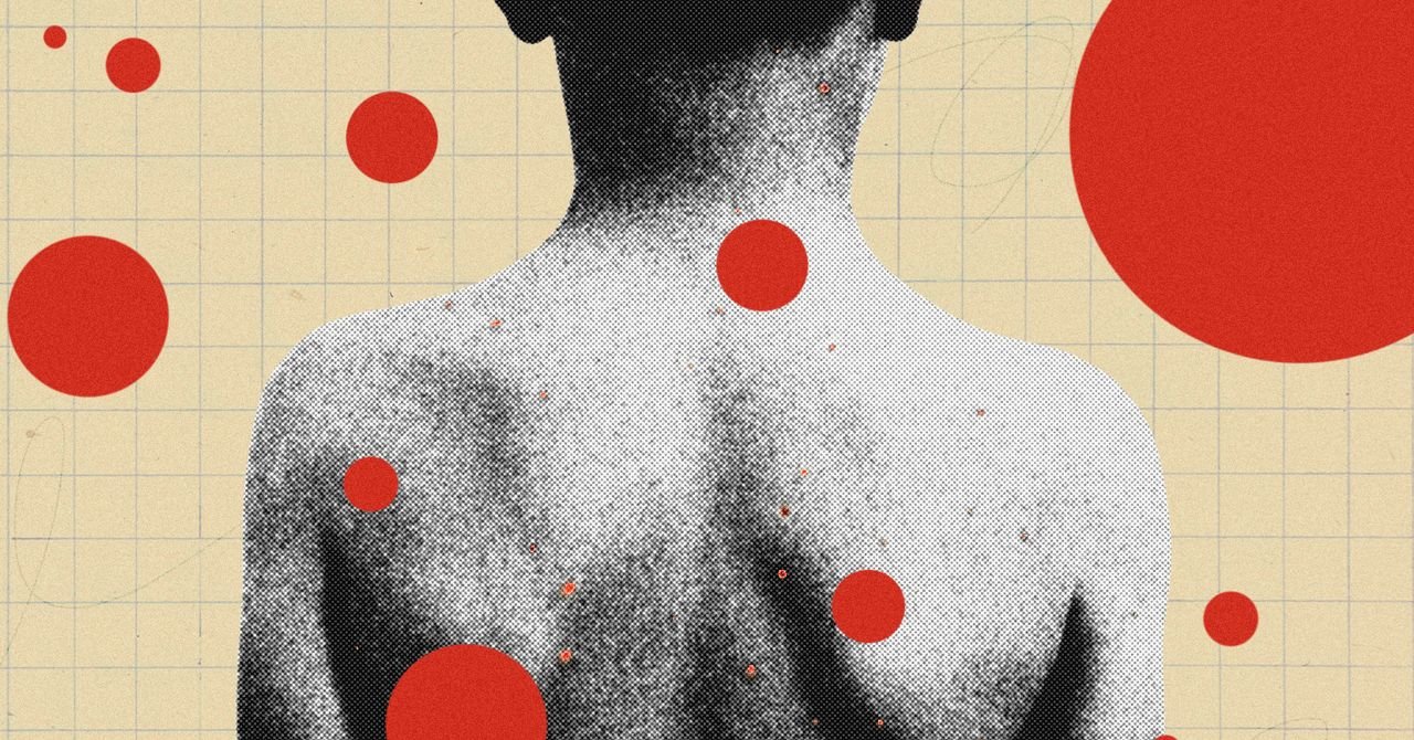 Illustration depicting a child with chickenpox blisters, symbolizing the historical prevalence of the virus before widespread vaccination.
