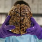 صورة توضيحية لخلايا سرطانية في الدماغ أو جسيمات نانوية تستهدف ورمًا دماغيًا